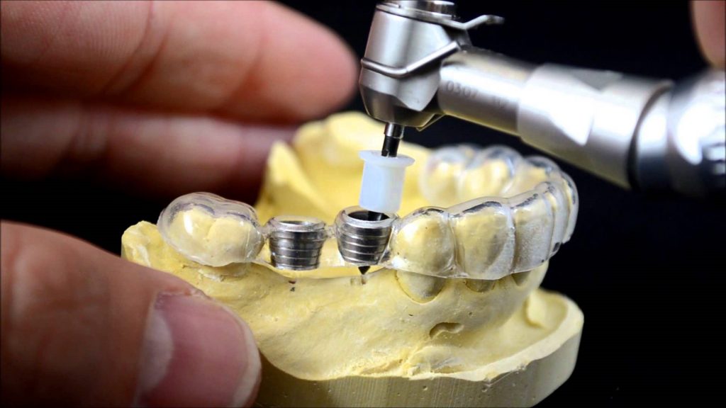 Máng định hướng cấy Implant